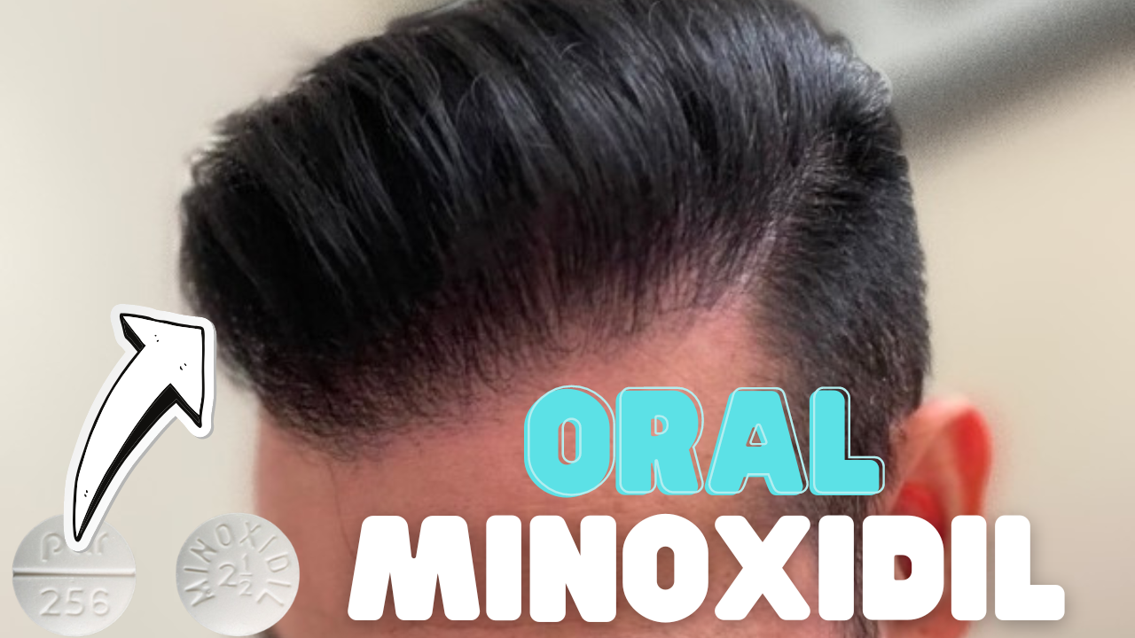 oral minoxidil for hair loss
