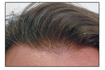 Natural hair hair transplant hair line