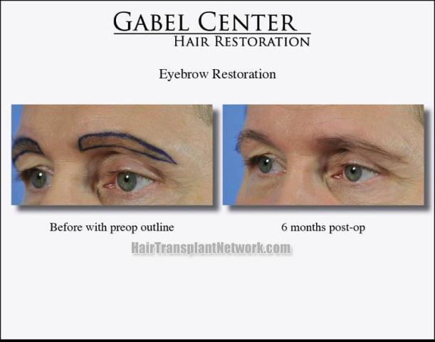 Eyebrow transplantation surgery before and after pictures