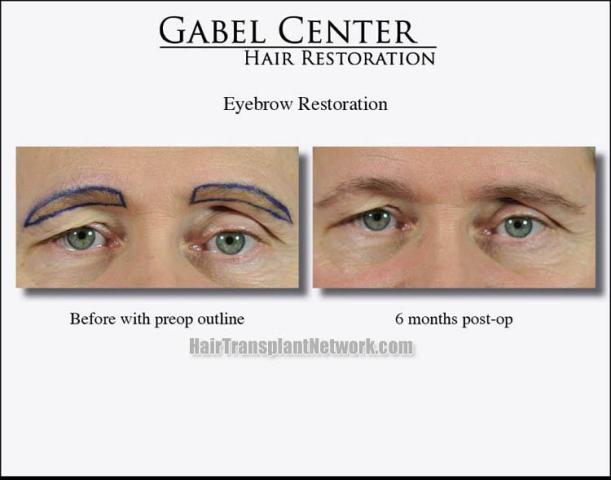 Eyebrow restoration procedure before and after results