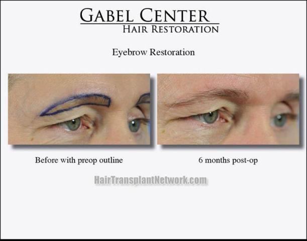 Eyebrow transplantation surgery before and after images