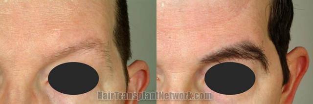 Eyebrow transplantation procedure before and after results