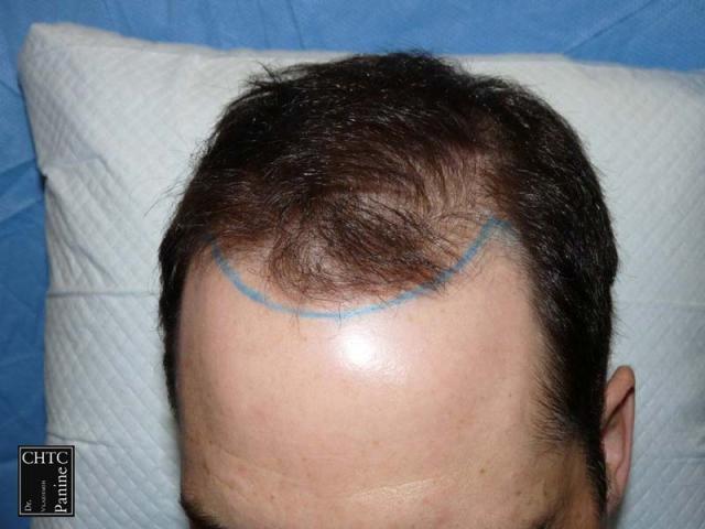 Frontal area before surgery