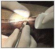 Donor strip being excised