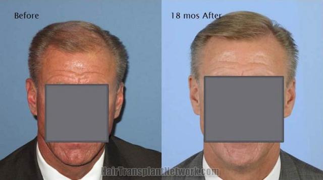 Front view - Before and 18 months after hair restoration surgery