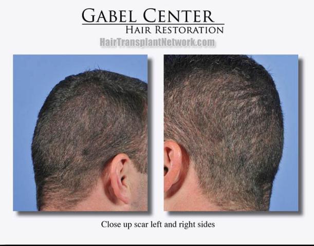 Surgical hair transplantation result photographs