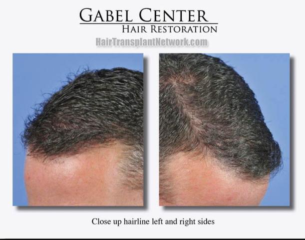 Hair replacement surgery before and after images