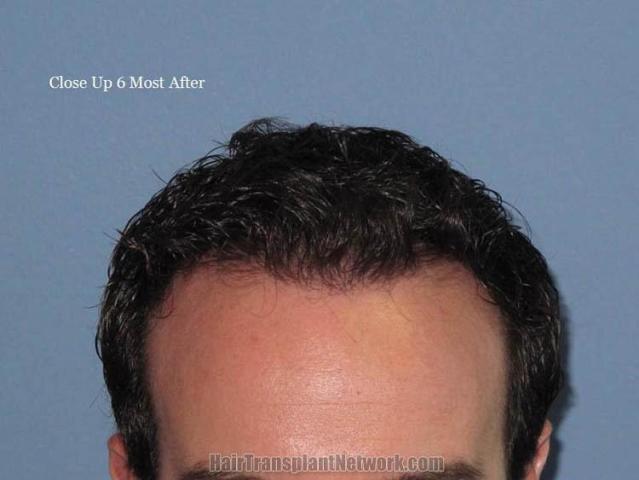 Hair restoration procedure front closeup image