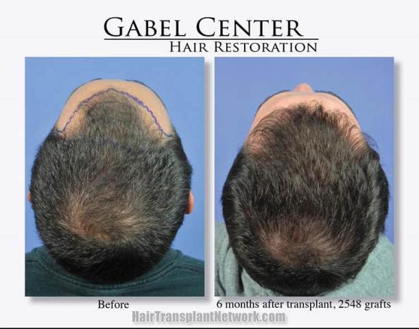 Back view before and after hair transplantation photos