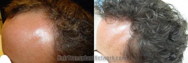 Hair restoration procedure result images