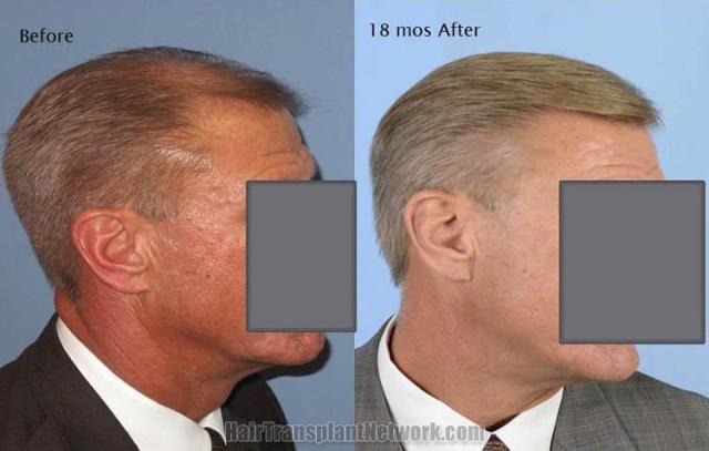 Hair transplantation surgery before and 18 months after images