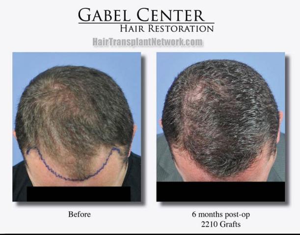 Top view before and after hair restoration results