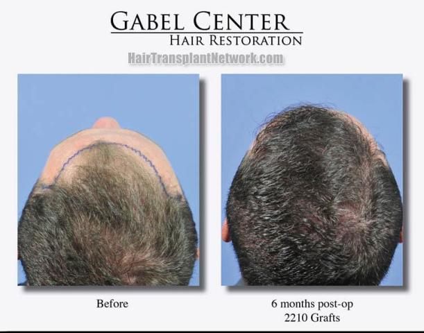 Back view before and after hair transplantation photos