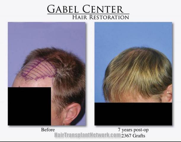 Hair transplant surgery before and after photos