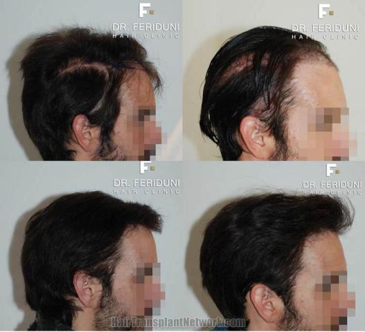 Hair transplantation surgery before and after images