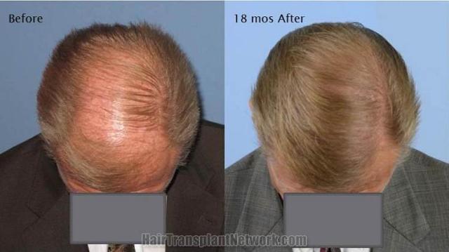 Hair restoration procedure before and 18 months after pictures