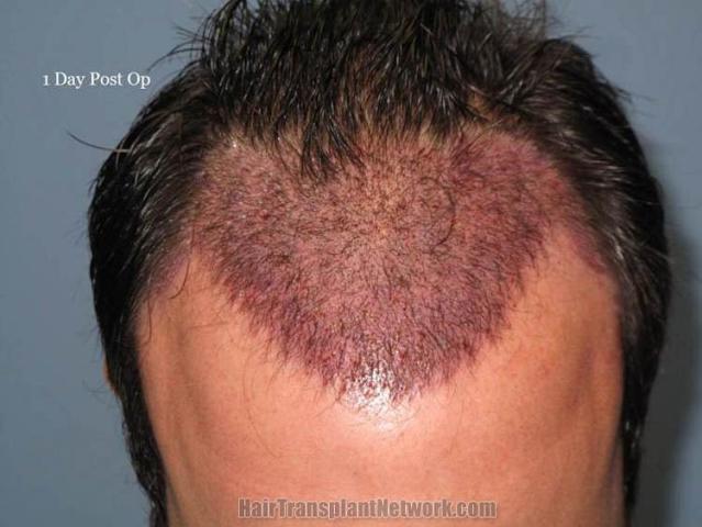 Hair restoration procedure immediate postoperative