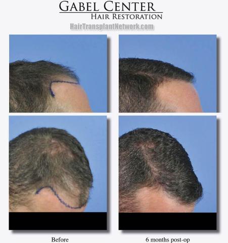 Before and after hair transplant procedure images