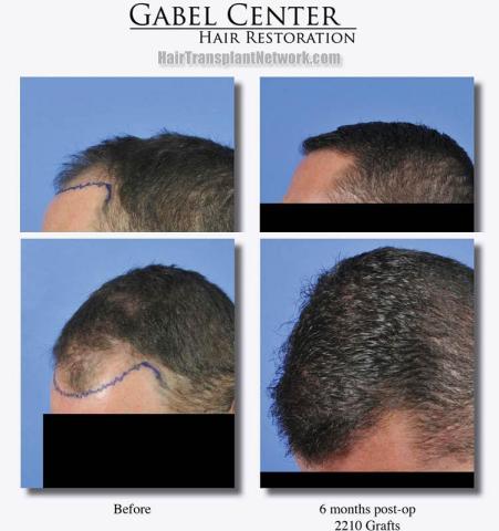 Hair restoration procedure before and after results