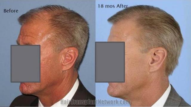 Hair transplantation surgery before and 18 months after pictures
