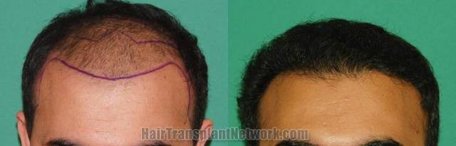 Before and after hair transplant procedure images