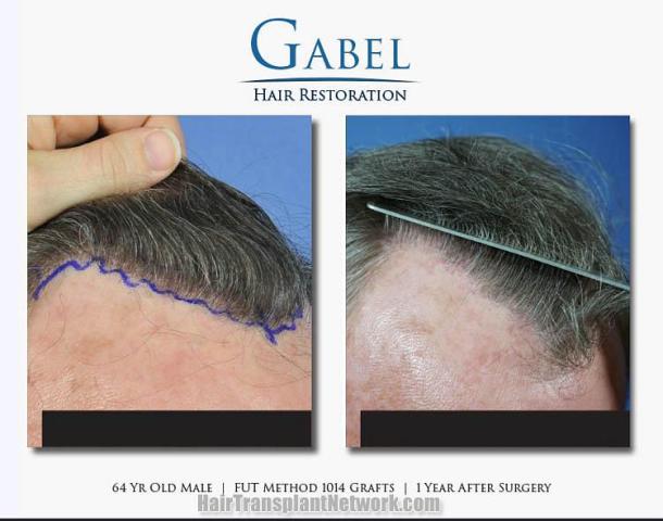 Hair restoration procedure before and after images