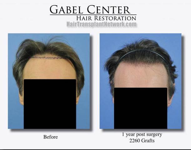 Front view - Before and after hair transplant surgery