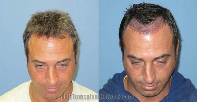 Hair restoration surgery before and after images