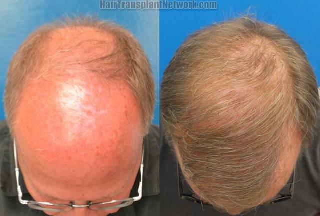 Top view before and after hair restoration results