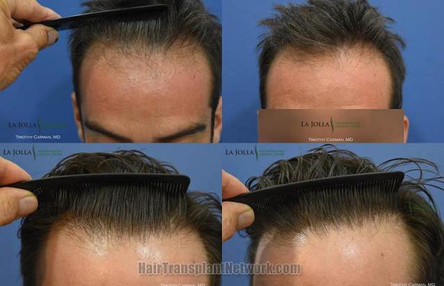 Hair restoration repair procedure before and after pictures