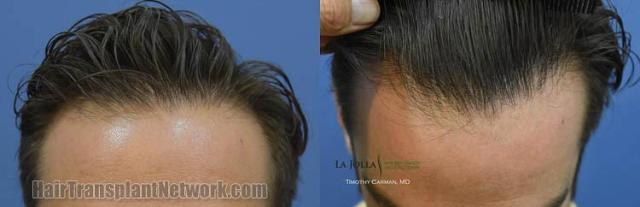 Before and after hair transplant restoration photos