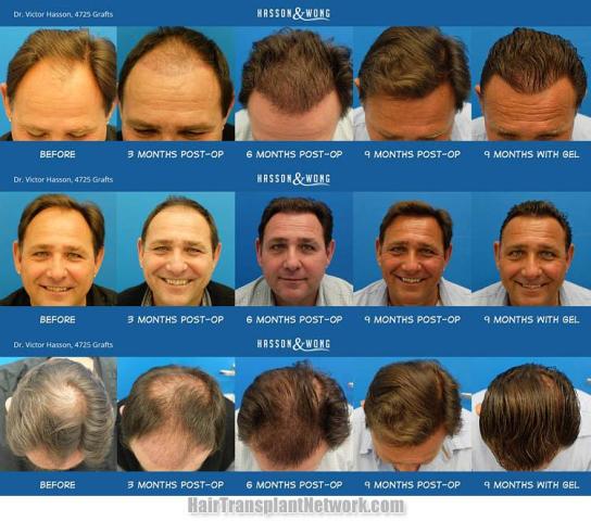  Before and after hair transplant surgery result images