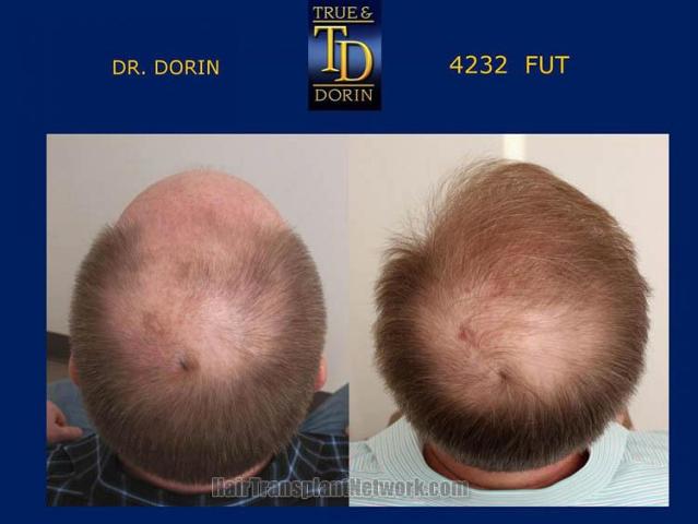 Hair replacement surgery before and after images