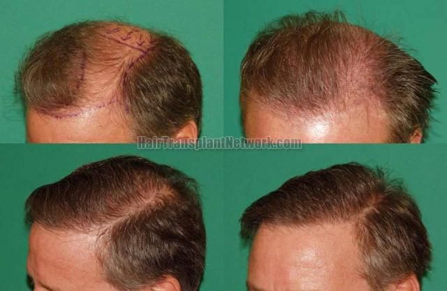 Hair restoration surgical procedure before and after pictures