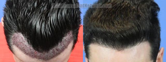 Top view - Before and after hair restoration results