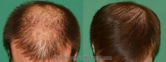 Top view - Before and after surgical hair replacement