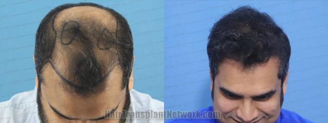 Dr. Arika Bansal Hair Transplant Procedure Before And After Result ...