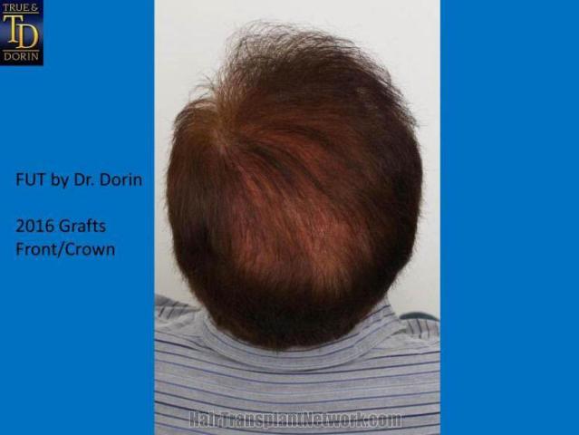 Hair transplant surgery before and after pictures