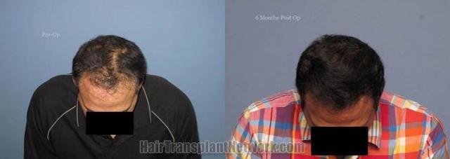 Hair transplant surgery before and after image