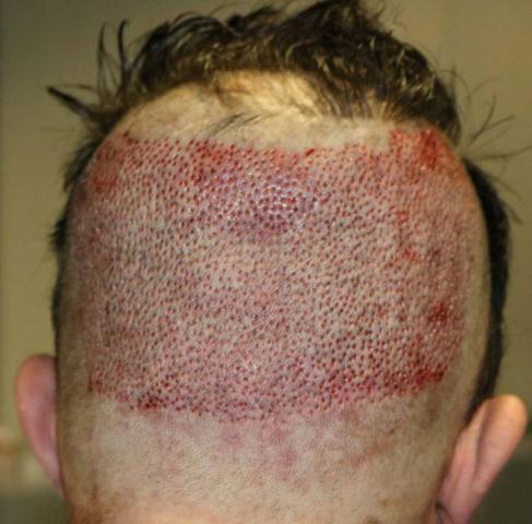 Back of patient, showing donor area immediately after FUE