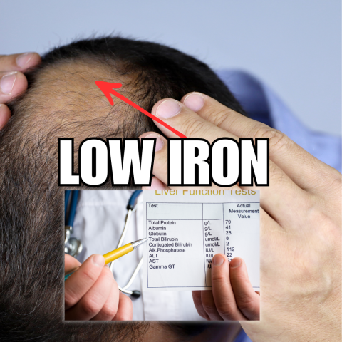 Can Low Iron Cause Hair Loss?