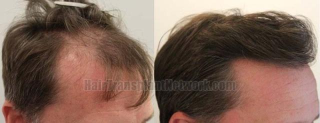 Right view of patient before and after