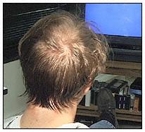 Hair combed over sutures