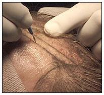 Incisions are made in the balding areas