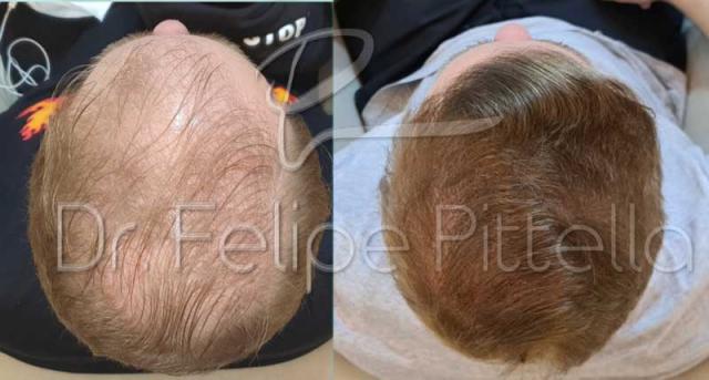 Top view of patient, before and after FUE surgery