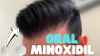Is Oral Minoxidil Safe For Hair Loss?