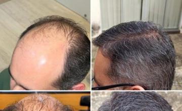 Dr. Pittella - 6095 grafts - 39 years old