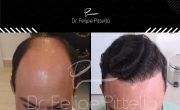 Dr. Pittella • Another Norwood 7 (maybe 6), 8633 grafts, Big forehead, average donor: Come and see (360º VIDEO)