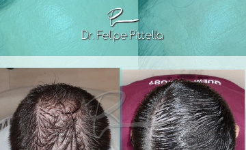 Dr. Pittella • Young patient, Diffuse Thinning, "can't get wet": SOLVED (WET)