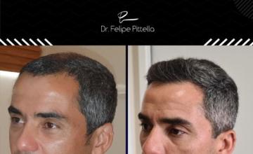 Dr. Pittella • 5159 grafts - Odd pattern baldness, Large area: SOLVED